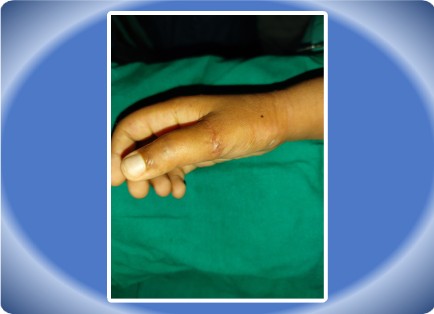 TENDON INJURY